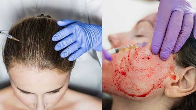 PRP for treating Hair Loss, Face Rejuvenation and Wrinkle Treatment