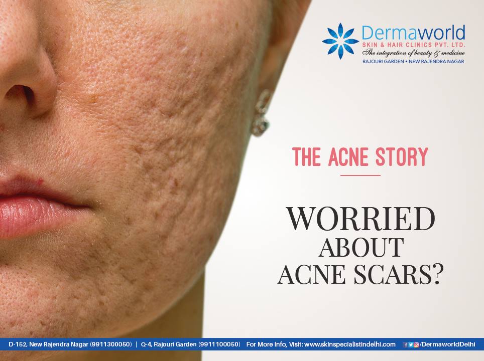 Bacne Scars Treatment
