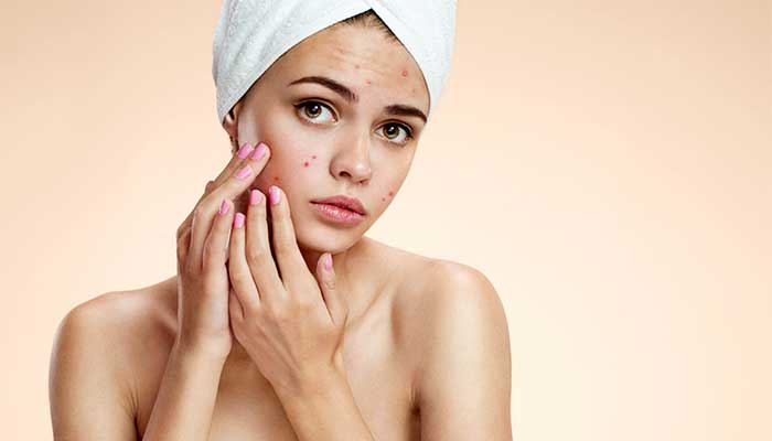 pimples skin care