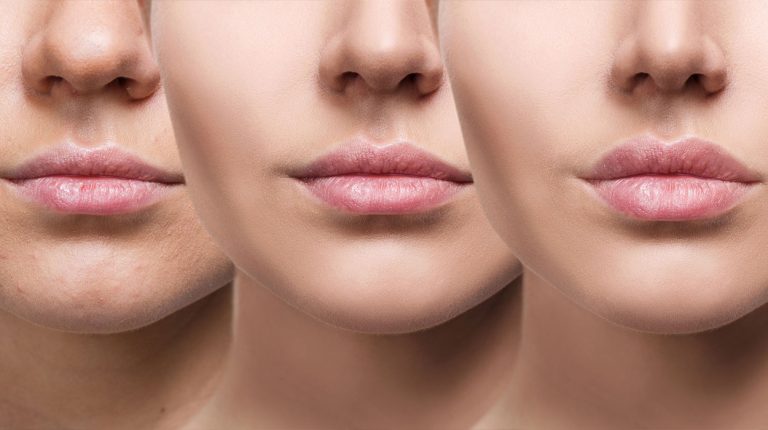 Lip Augmentation by Dermal Fillers