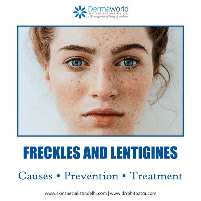 Lentig & Freckles Removal Treatment