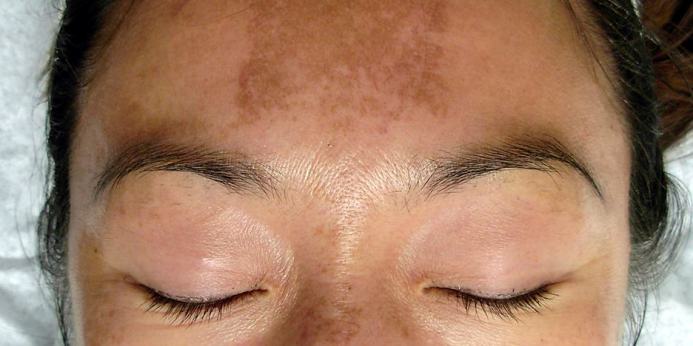 8 Key Benefits of Laser Toning- Regain Even Toned Texture & Colour |  DermaWorld Skin Clinic