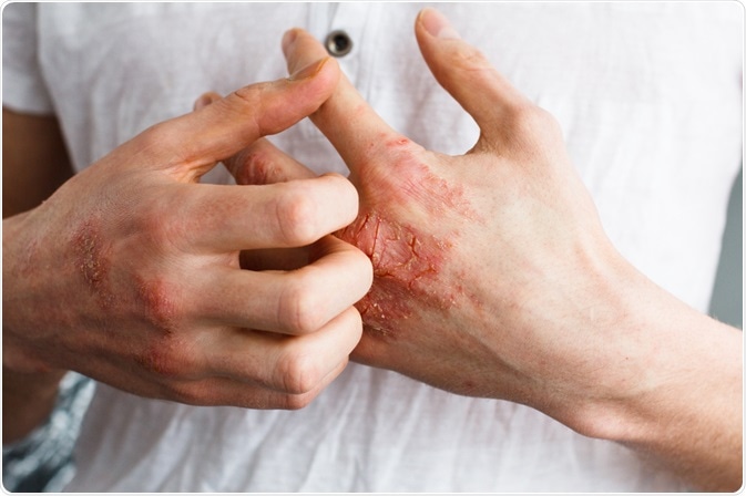 skin disease