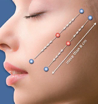 Silhouette Soft Threadlift