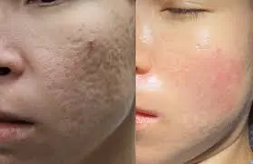 acne scars removal treatment in Delhi