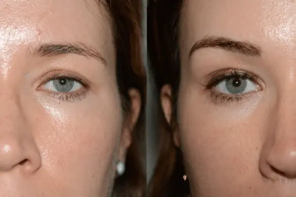 eyebrow lift surgery in Delhi