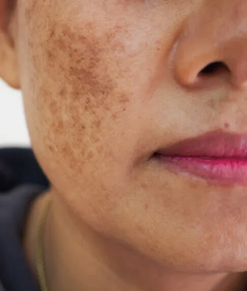 melasma treatment in delhi